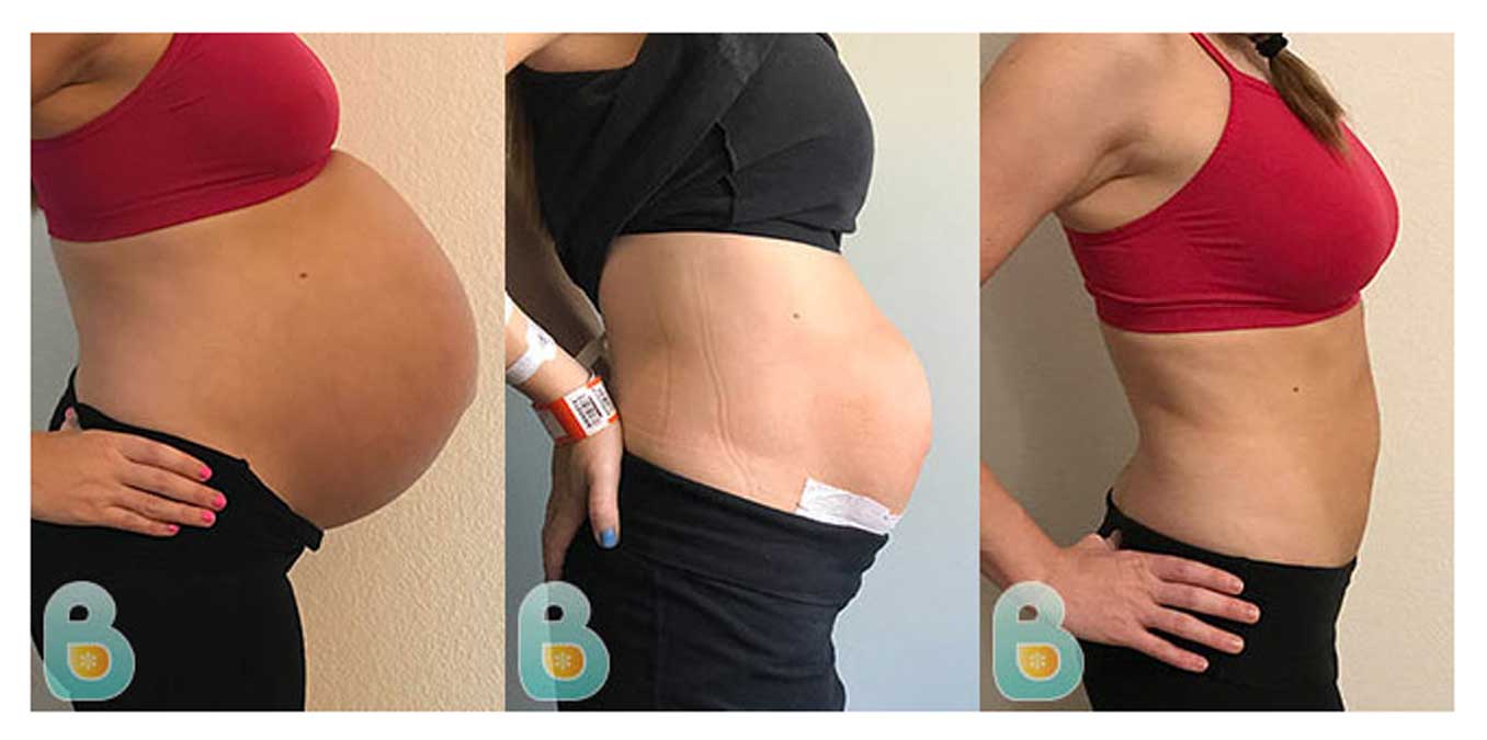 C Section Recovery Band Helps Mom Eliminate Pain & Gain Confidence