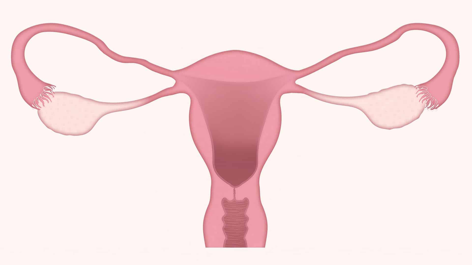 Incomplete Uterovaginal Prolapse