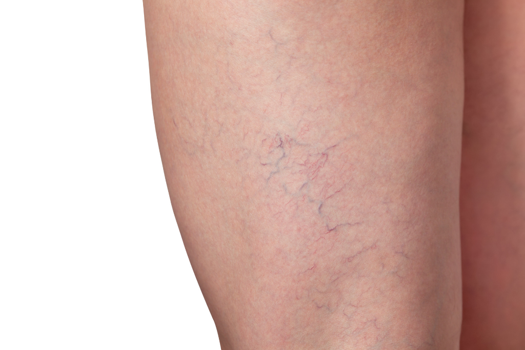 What Are Spider Veins and How to Treat Them?