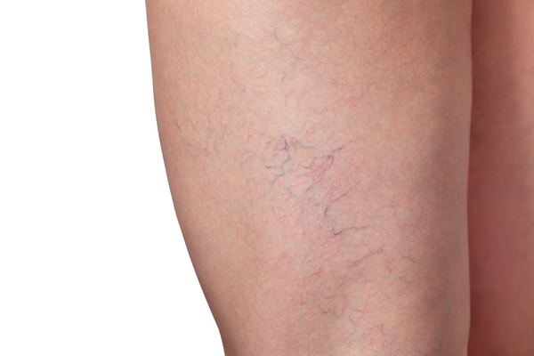 What Are Spider Veins and How to Treat Them?