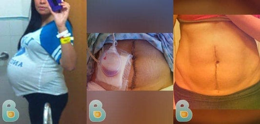 130-Merce-M-Bellefit-Results-Before-and-After-Bellefit-SLIDE
