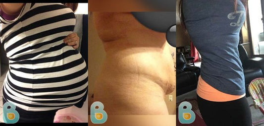155-Tara-B-Bellefit-Results-Before-and-After-Bellefit-SLIDE