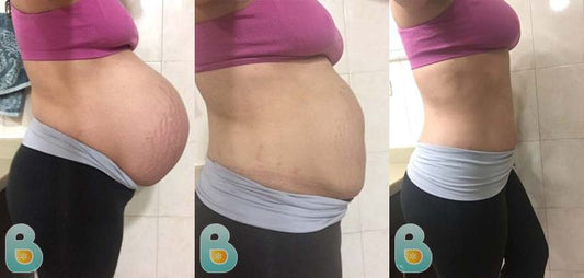 156-Tawny-M-Bellefit-Results-Before-and-After-Bellefit-SLIDE