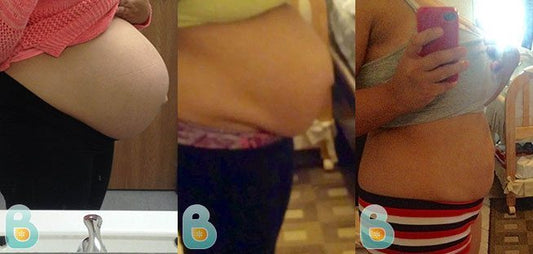 177-Anabel-F-Bellefit-Results-Before-and-After-Bellefit-SLIDE