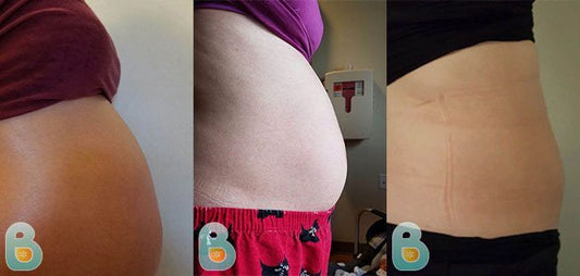 191-Andrie-A-Bellefit-Results-Before-and-After-Bellefit-SLIDE