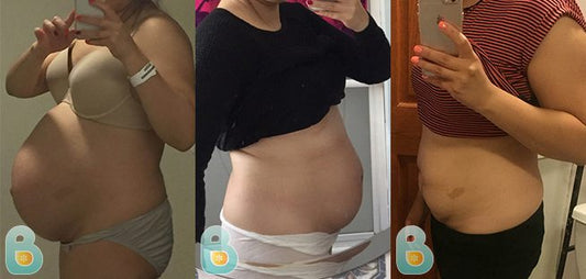 206-Celenia-V-Bellefit-Results-Before-and-After-Bellefit-SLIDE