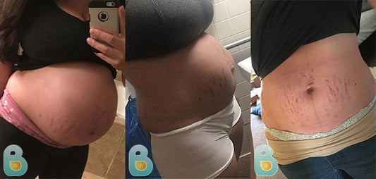 209-Areeg-S-Bellefit-Results-Before-and-After-Bellefit-SLIDE