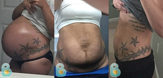 211-Kimberly-K-Bellefit-Results-Before-and-After-Bellefit-SLIDE