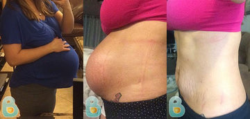 241-Beatriz-S-Bellefit-Results-Before-and-After-Bellefit-SLIDE