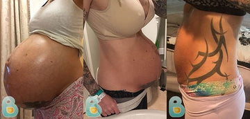 246-Nicole-L-Bellefit-Results-Before-and-After-Bellefit-SLIDE