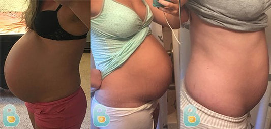 261-Melissa-H-Bellefit-Results-Before-and-After-Bellefit-SLIDE