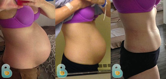 280-Samantha-S-Bellefit-Results-Before-and-After-Bellefit-SLIDE