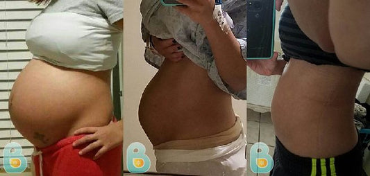 323-Juanita-P-Bellefit-Results-Before-and-After-Bellefit-SLIDE