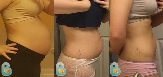 329-Chelsea-W-Bellefit-Results-Before-and-After-Bellefit-SLIDE