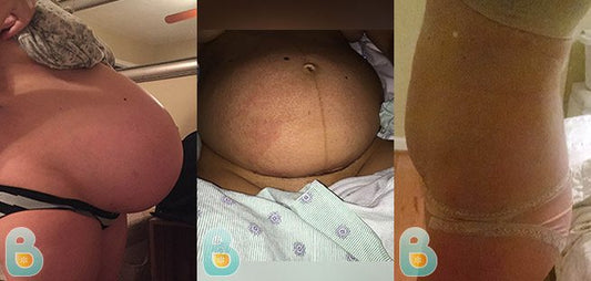 333-Giselle-S-Bellefit-Results-Before-and-After-Bellefit-SLIDE