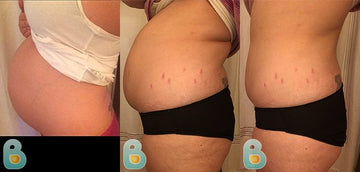 334-Loreen-D-Bellefit-Results-Before-and-After-Bellefit-SLIDE