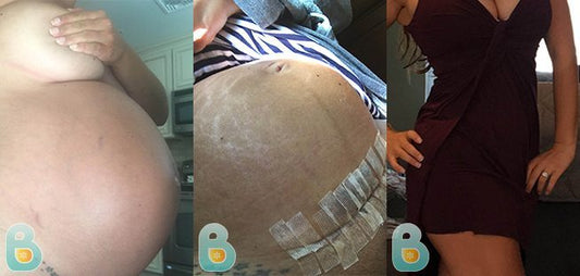 343-Nichole-T-Bellefit-Results-Before-and-After-Bellefit-SLIDE