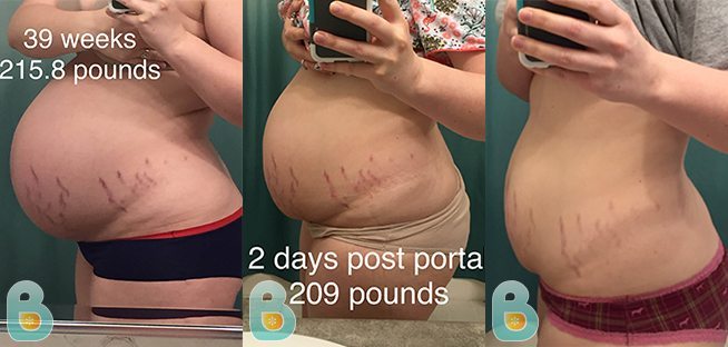 Comparing My Two C-Section Progress