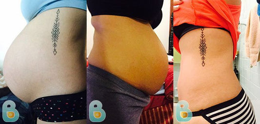 361-Rosa-E-Bellefit-Results-Before-and-After-Bellefit-SLIDE