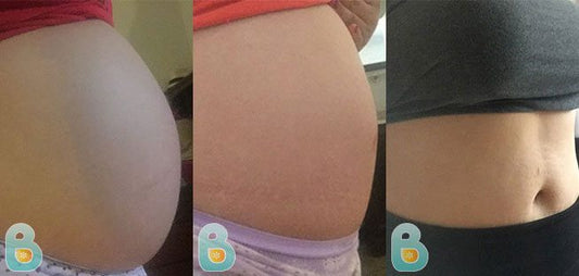 375-Maria-R-Bellefit-Results-Before-and-After-Bellefit-SLIDE