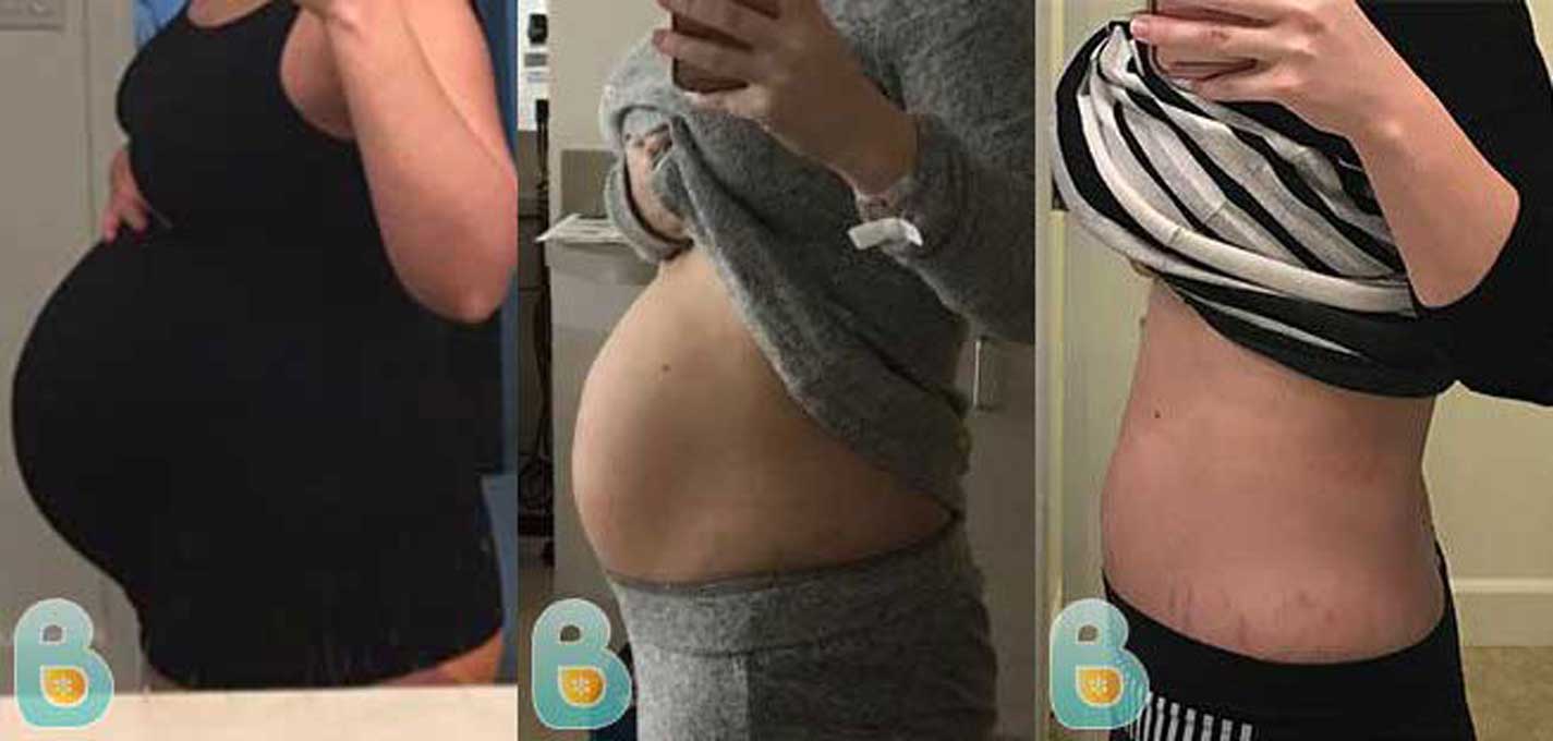 Bellefit Spared Mom of Surgery After Severe Diastasis