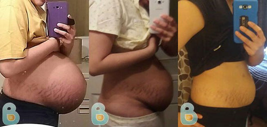 381-Elizabeth-F-Bellefit-Results-Before-and-After-Bellefit-SLIDE