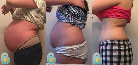 383-Evangelina-G-Bellefit-Results-Before-and-After-Bellefit-SLIDE