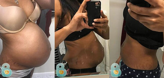 399-Nicole-W-Bellefit-Results-Before-and-After-Bellefit-SLIDE