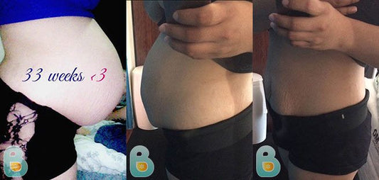 405-Lizeth-G-Bellefit-Results-Before-and-After-Bellefit-SLIDE