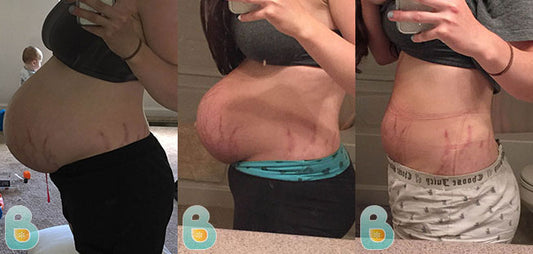 474-Nicole-J-Bellefit-Results-Before-and-After-Bellefit-SLIDE