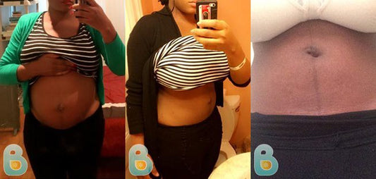 65-Ijeoma-O-Bellefit-Results-Before-and-After-Bellefit-SLIDE