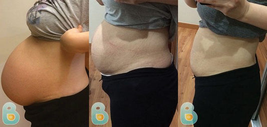 68-Jane-C-Bellefit-Results-Before-and-After-Bellefit-SLIDE
