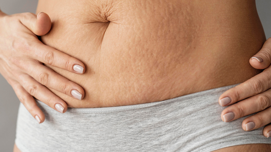 Understanding and Managing Stretch Marks