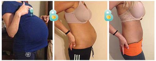 postpartum girdle results